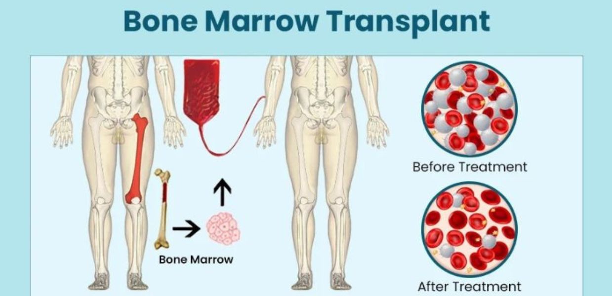Bone Marrow Transplant